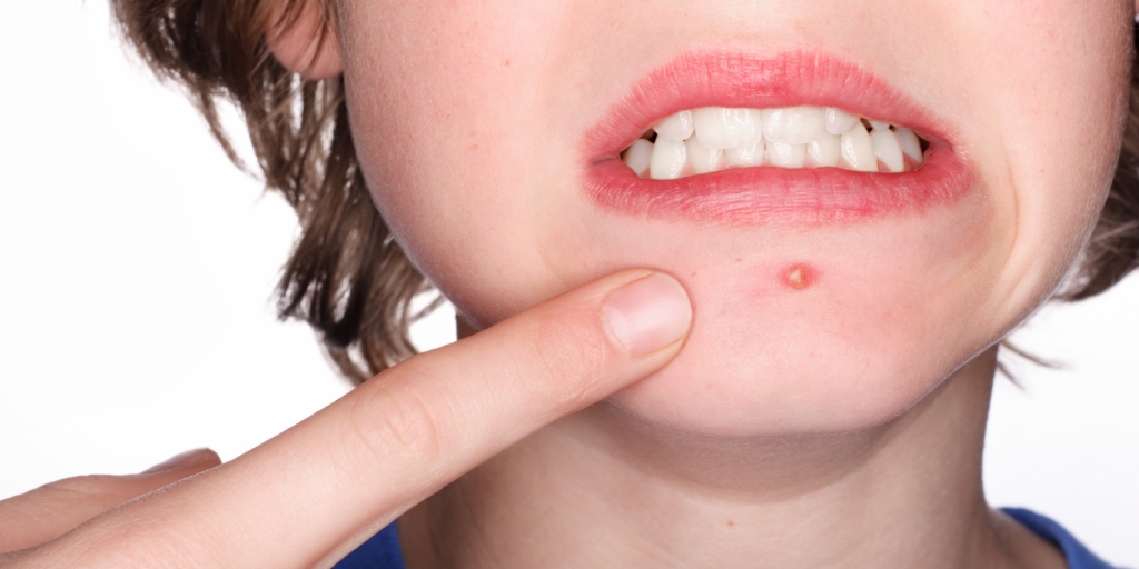 o-PIMPLE-facebook.jpg